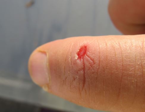 Die Riß- Schnittverletzung an meinem Zeigefinger durch das Blech der Erdnussdose 